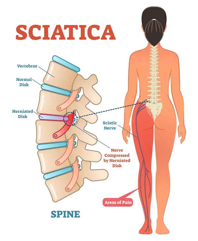 sciatic nerve diagram